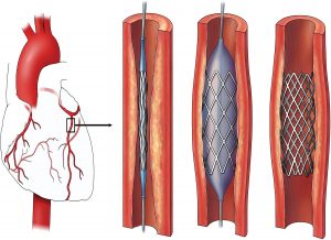  How long it takes to recover after Coronary Angioplasty?