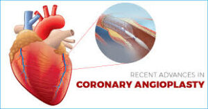Coronary angioplasty