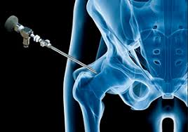 Risk and Complications Related to Hip Arthroscopy