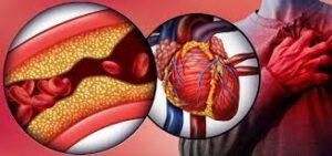 coronary arteries diseases
