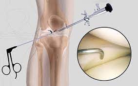 treated by knee arthroscopy