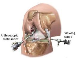treated by knee arthroscopy