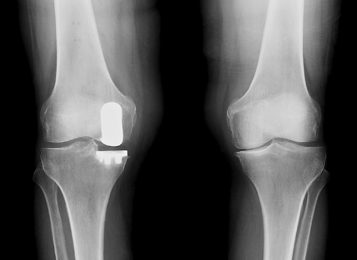 Partial knee Replacement procedure