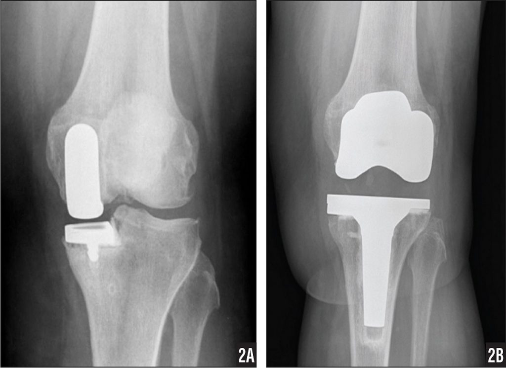 What is Unicompartmental Knee Arthroplasty?
