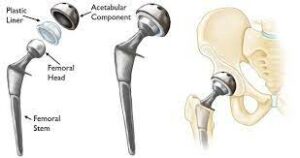 What Happens During Hip Replacement Surgery