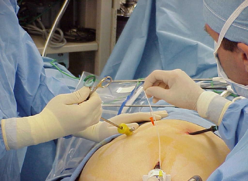 How laparoscopy is Performed?