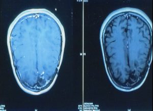 Diagnosis Of Brain Tumor