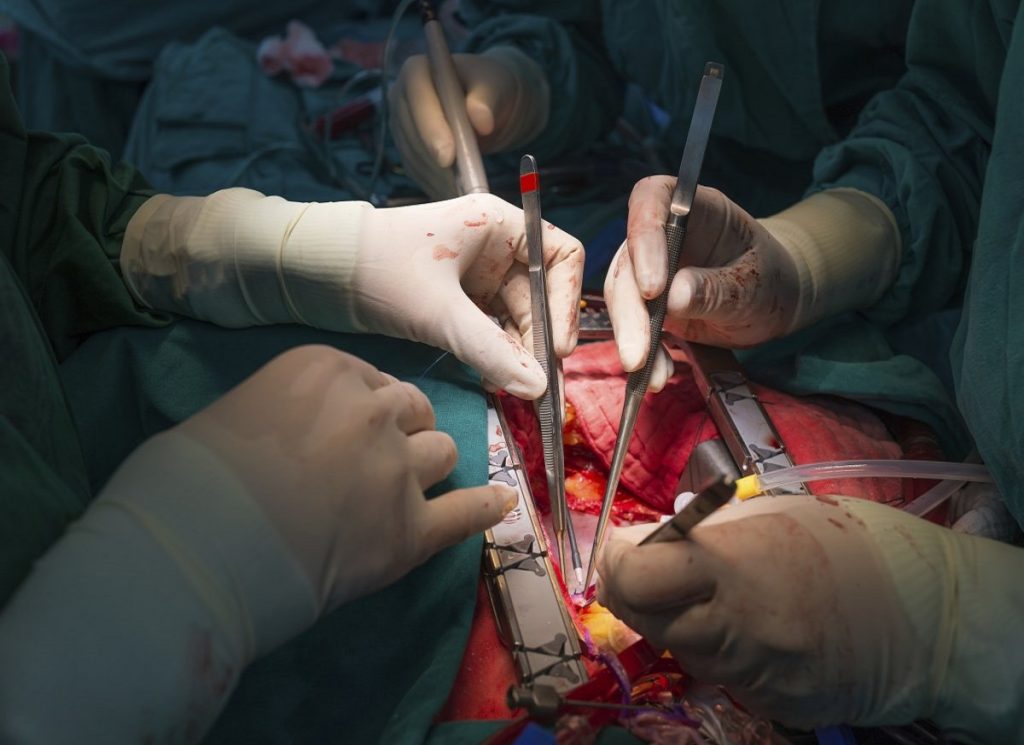 Minimally Invasive Heart Bypass Surgery