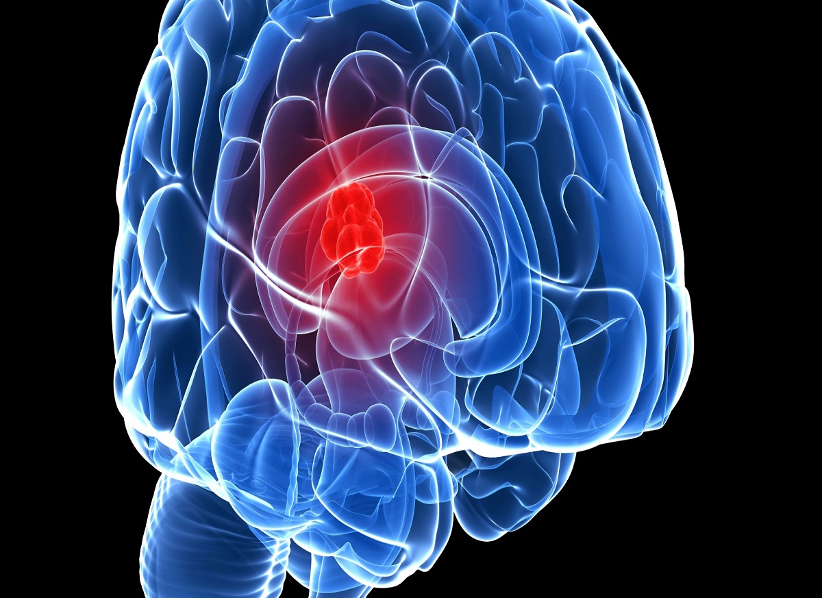 brain-tumor-facts