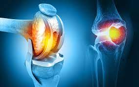 If you are under 50, you are too young to have joint replacement surgery