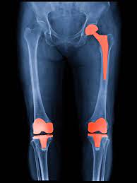 Joint replacement surgery means a long hospital stay