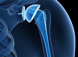  Shoulder Replacement Surgery – Diagnosis, Treatment and Recovery