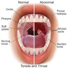 Throat or Jaw pain