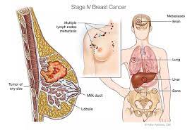 metastatic breast cancer